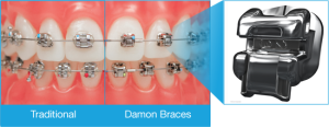 Choose-Compare-Braces