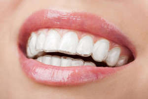 Trattamenti-ortodonzia invisalign 2