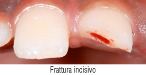 Traumi-dentali-1a