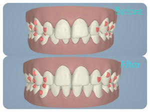 gck_beforeafterattachments