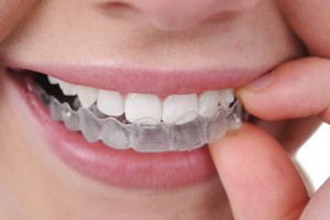 invisalign5