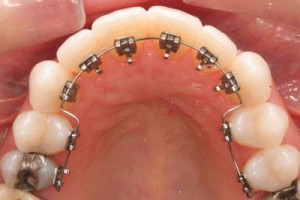 ortodonzia-linguale_O2